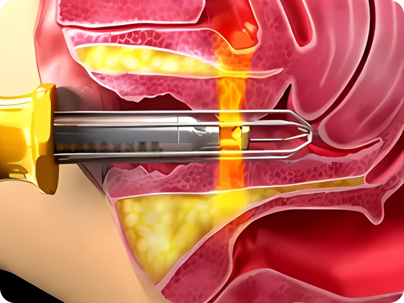 레이저 질타이트닝 VLT